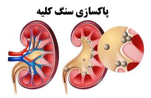 با سنگ کلیه خداحافظی کن!